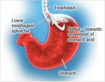 heartburn causes